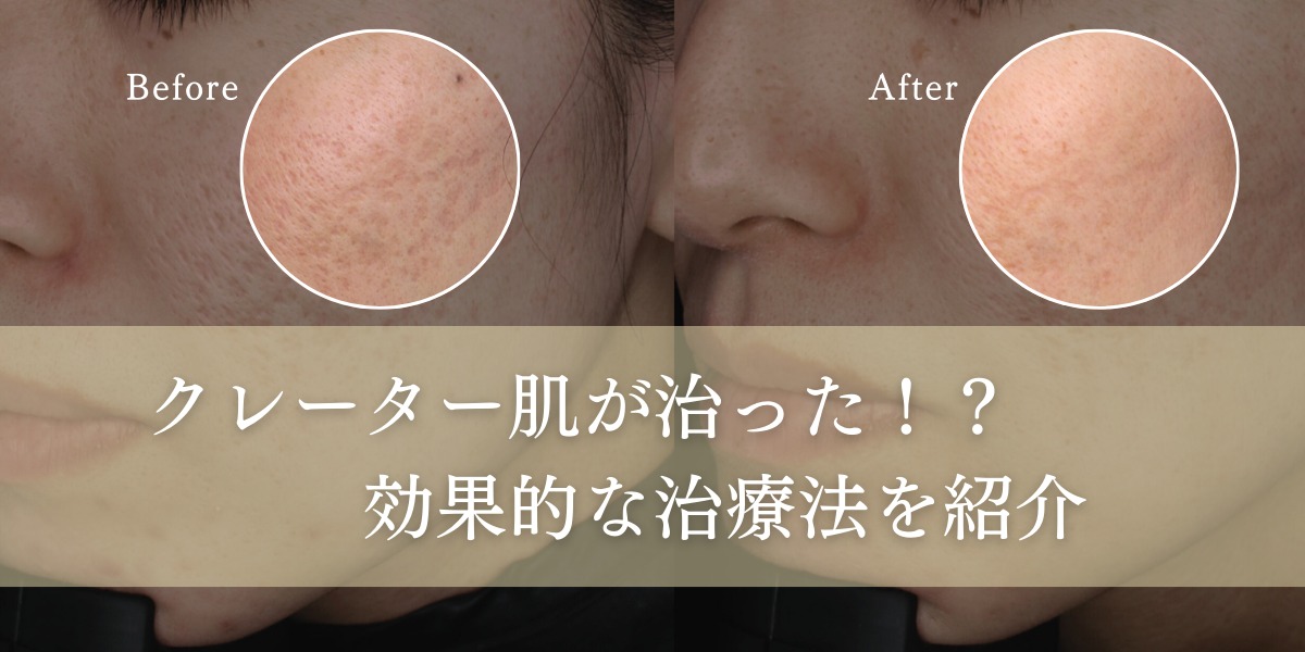 クレーター肌が治った!?効果的な治療法を紹介します