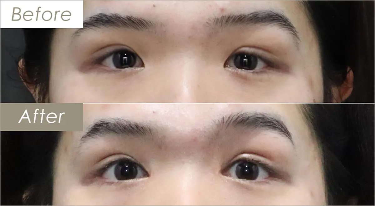 目頭切開法（Ｚ形成）の施術例-症例写真