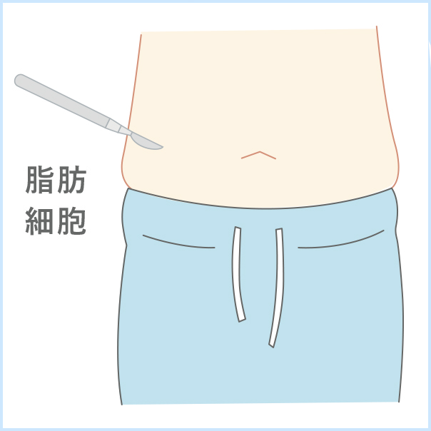 自己脂肪由来幹細胞