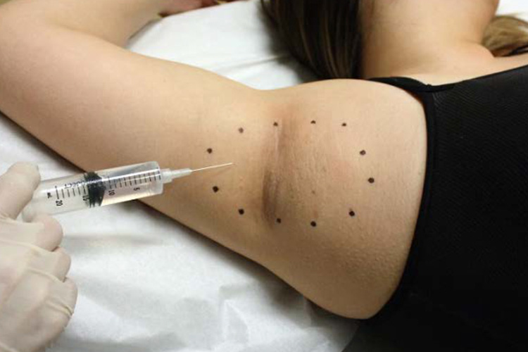 ミラドライを施術する前に腋に局所注射をする