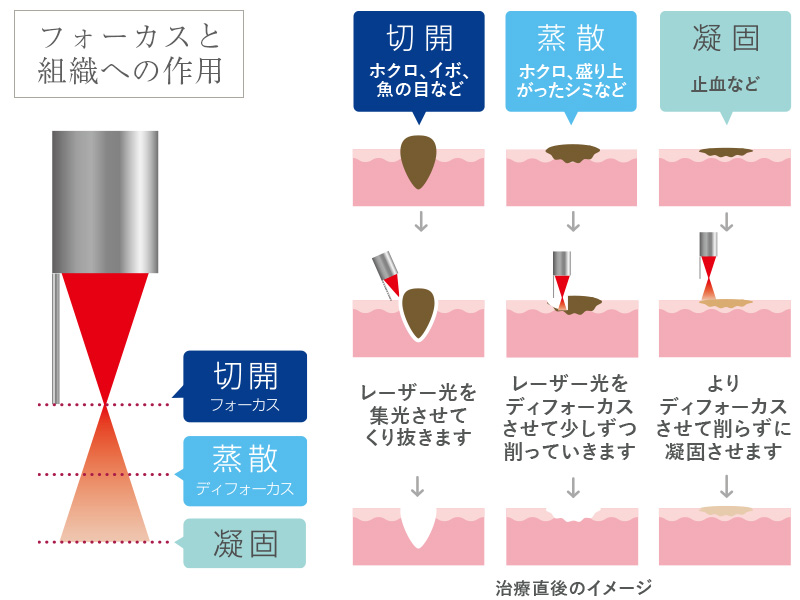 炭酸ガス（CO2）レーザーの作用