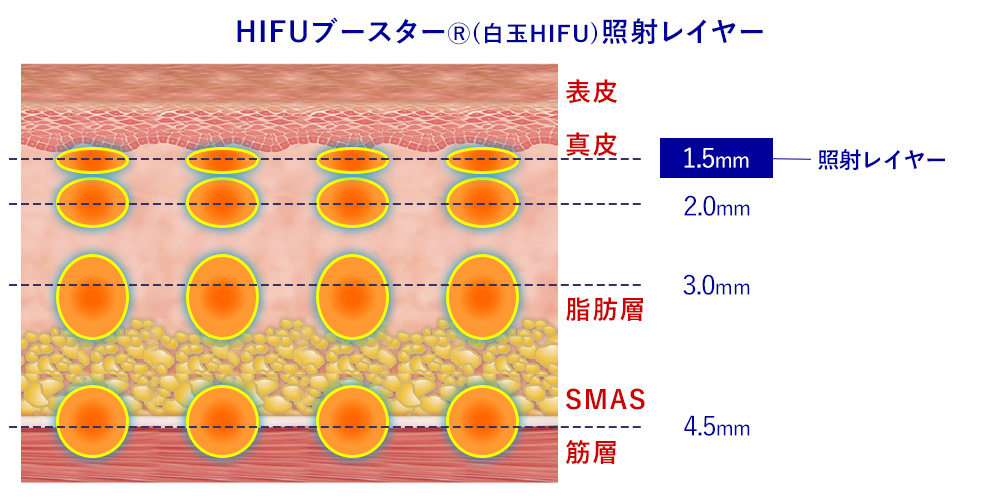 HIFUブースター(白玉HIFU)照射レイヤー