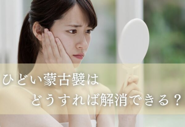 ひどい蒙古襞はどうすれば解消できる？