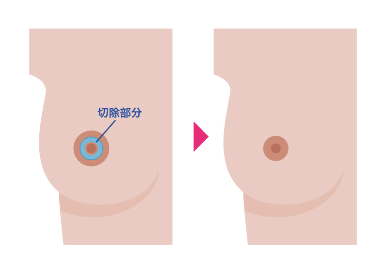 乳輪縮小術（内側切開法）