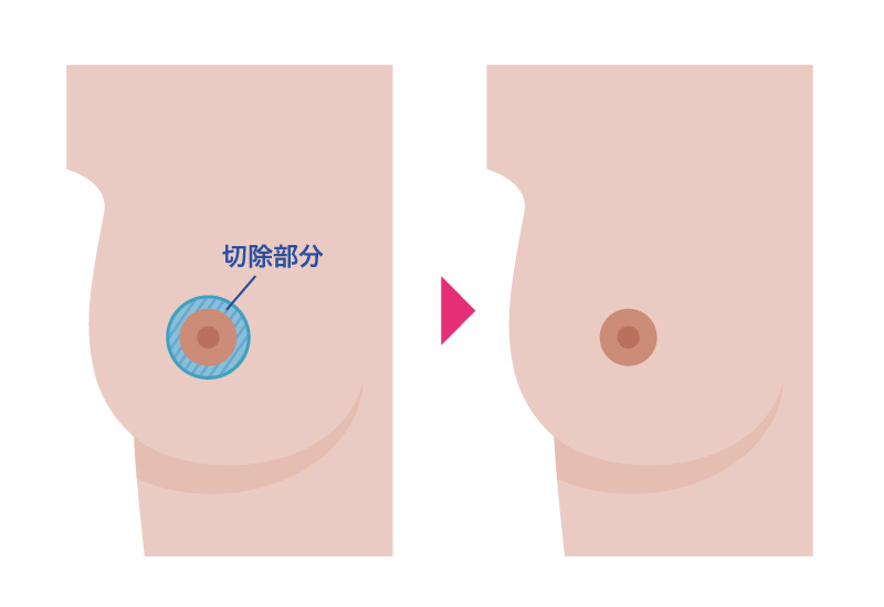乳輪縮小術（外側切開法）