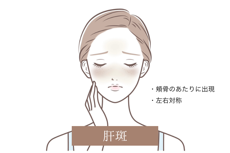 肝斑