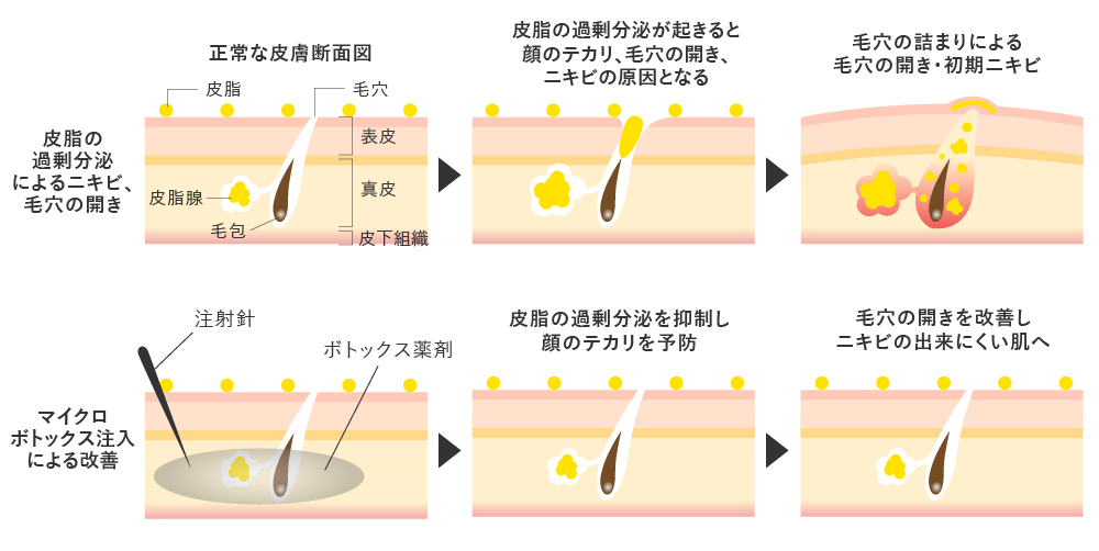 ボトックスリフトは皮脂の過剰な分泌を抑え、ニキビをできにくくする効果がある
