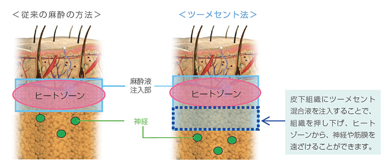 ミラドライ　麻酔方法
