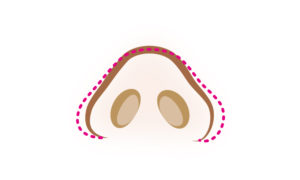 小鼻縮小術