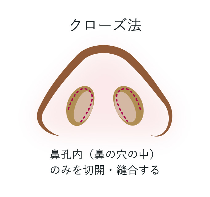 鼻尖形成術 クローズ法