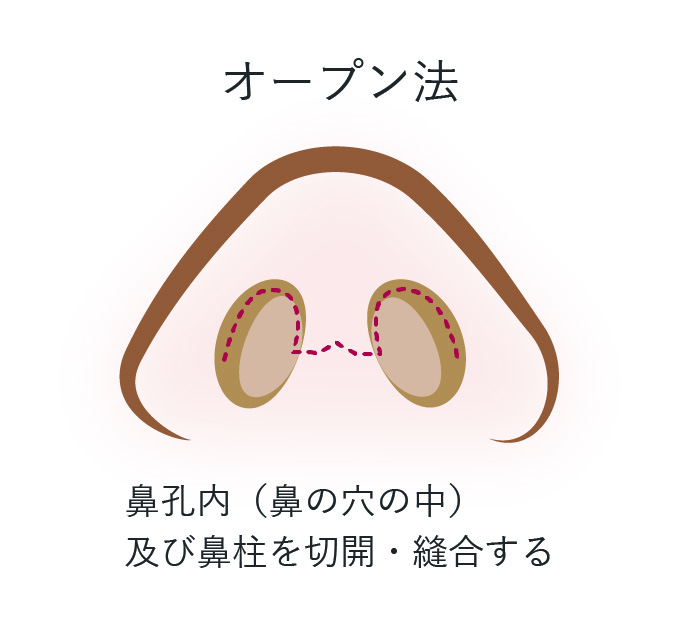 鼻尖形成術 オープン法
