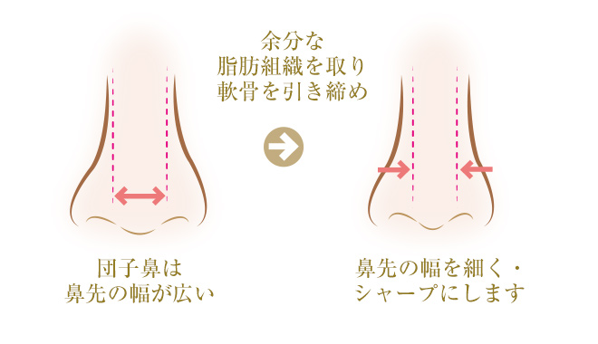 鼻尖形成術で鼻先の幅を細く、シャープにする
