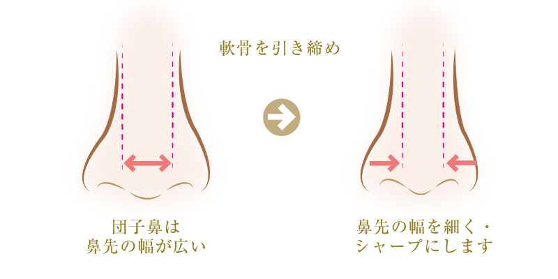 切らない鼻尖形成術はなっこつを引き締め鼻先をシャープにします
