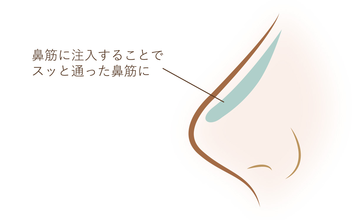 鼻筋へのヒアルロン酸注射でスッと通った鼻筋に