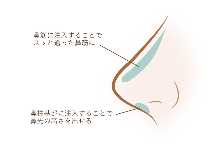 鼻筋へのヒアルロン酸注射でスッと通った鼻筋に