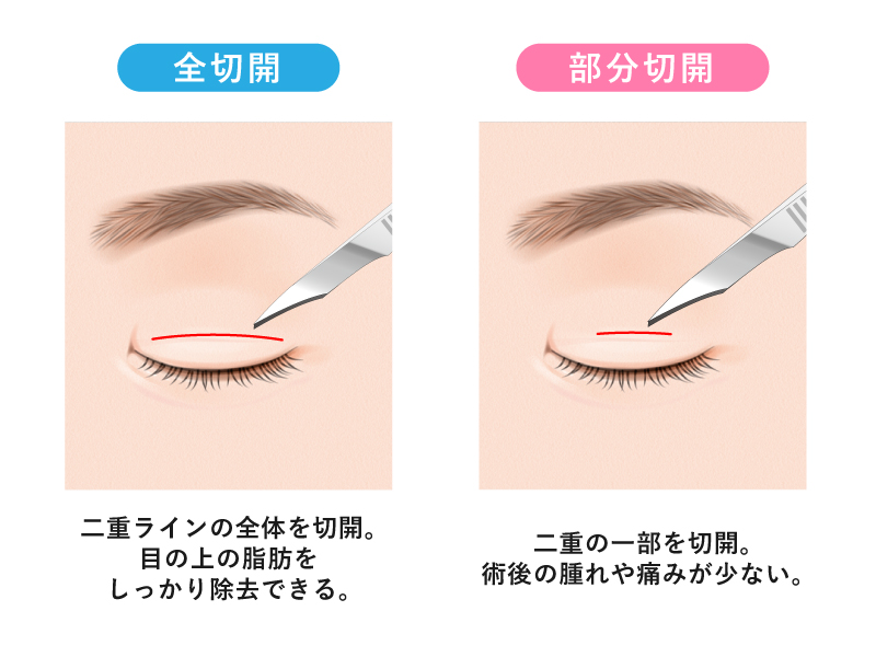 二重全切開法と部分切開法の違い