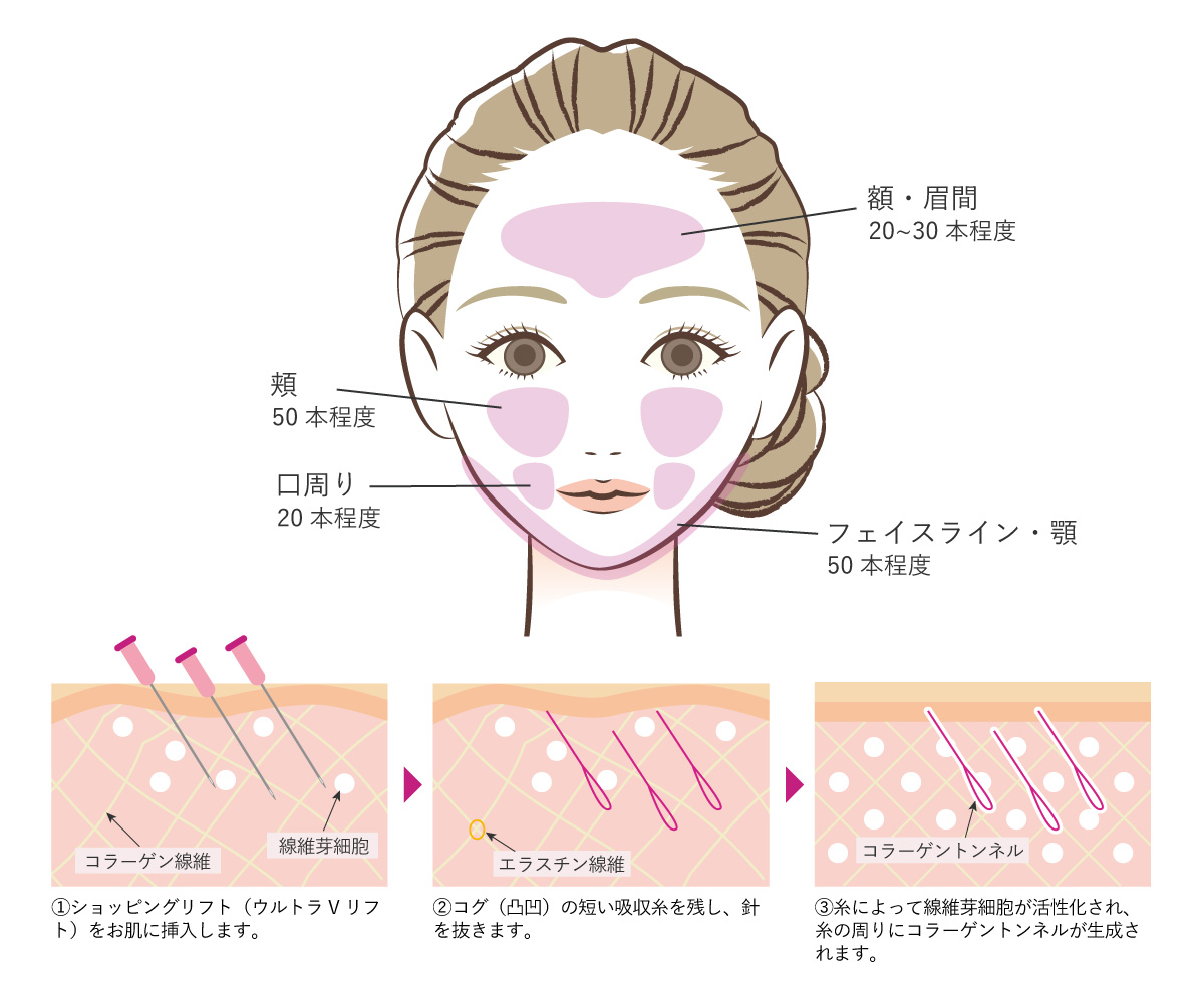 ショッピングリフトの施術箇所・施術方法