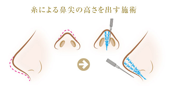 糸による鼻尖の高さを出す施術