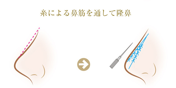 糸による鼻筋を通して隆鼻