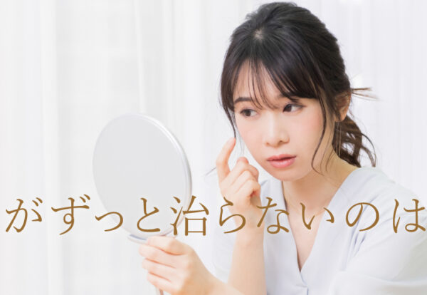 ニキビがずっと治らないのはなぜ？早く治すための方法とは？！