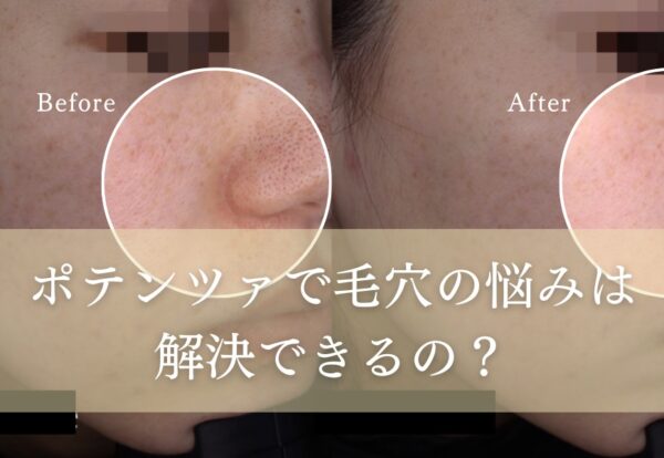 ポテンツァで毛穴の悩みは解消できるの？