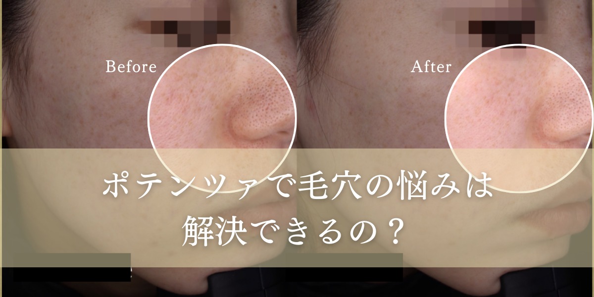 ポテンツァで毛穴の悩みは解決できるの？