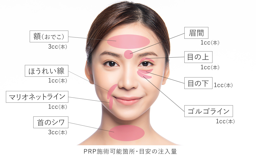 PRP施術可能箇所・目安の注入量