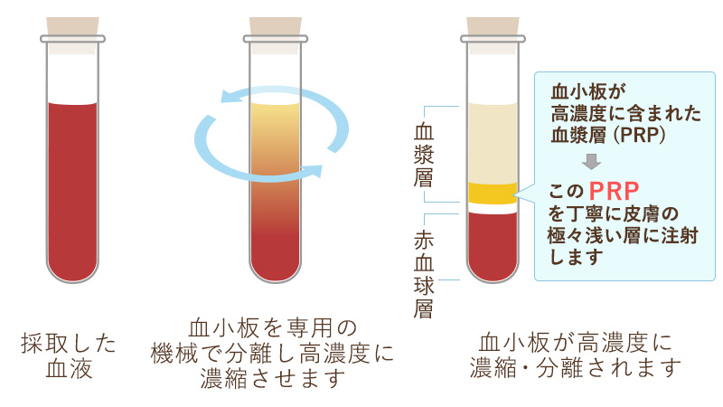 プライベートスキンクリニック　PRP皮膚再生療法