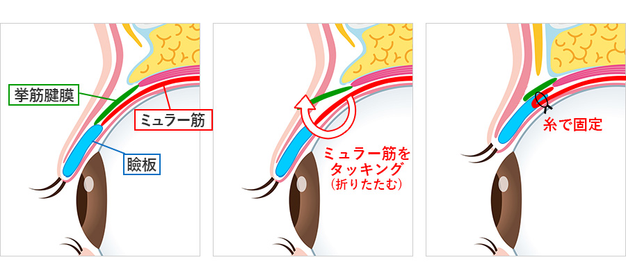 切らない眼瞼下垂手術の仕組み