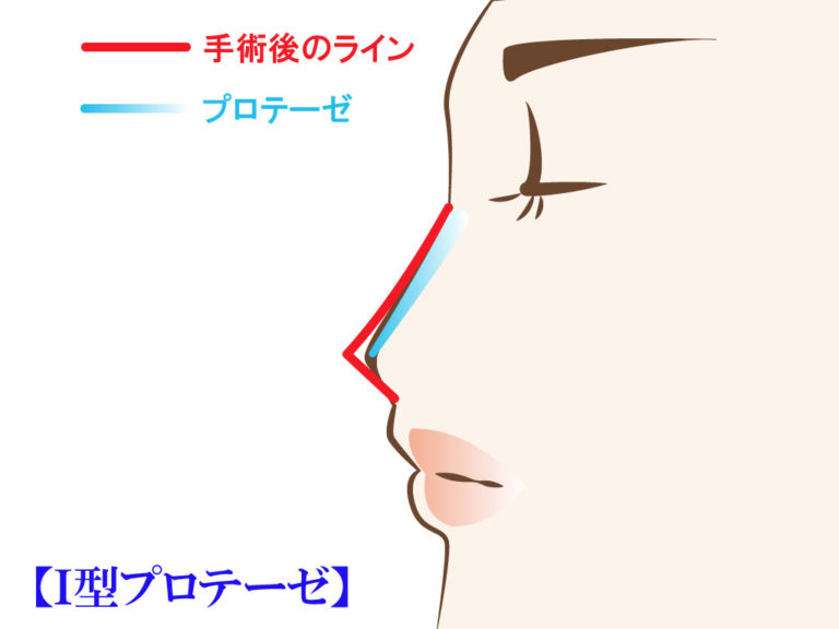 I型プロテーゼ挿入ライン