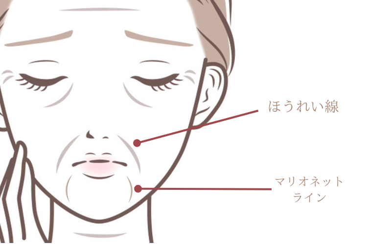 ほうれい線とマリオネットライン