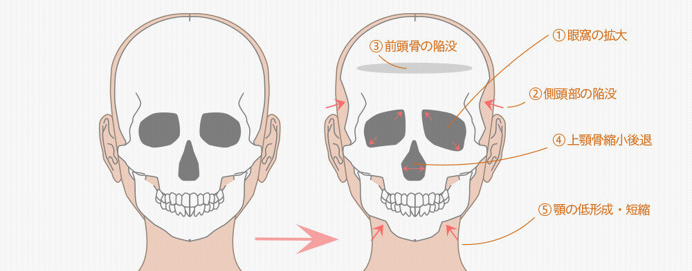加齢による骨の変化のたるみ
