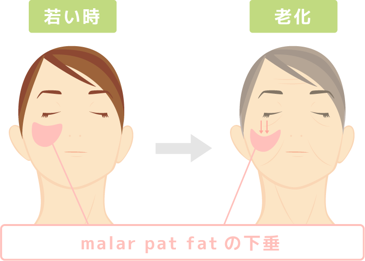 頬の脂肪のたるみ　若い時と老化