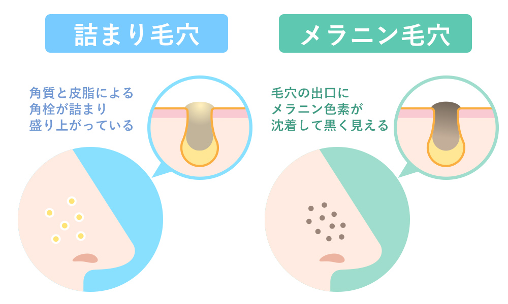 いちご鼻になる理由 詰まり毛穴とメラニン毛穴