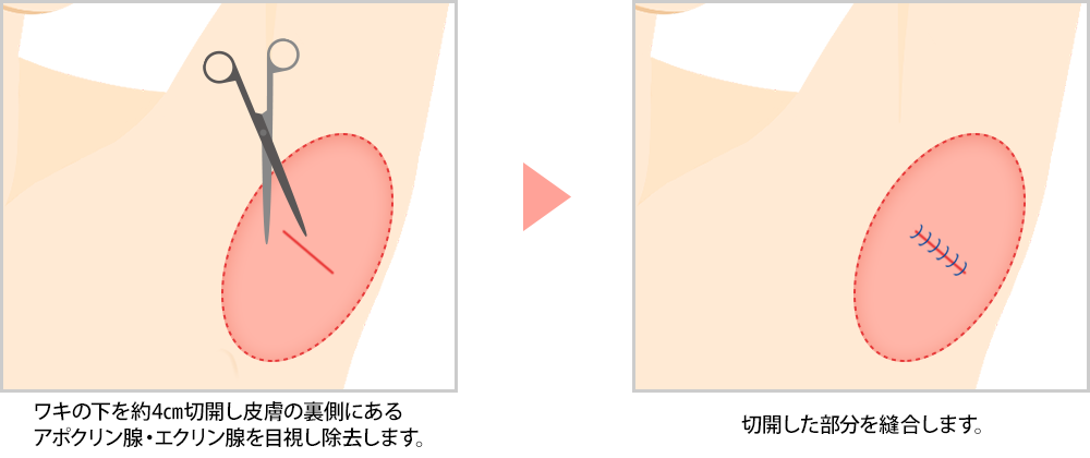 わきが手術の直視下法について