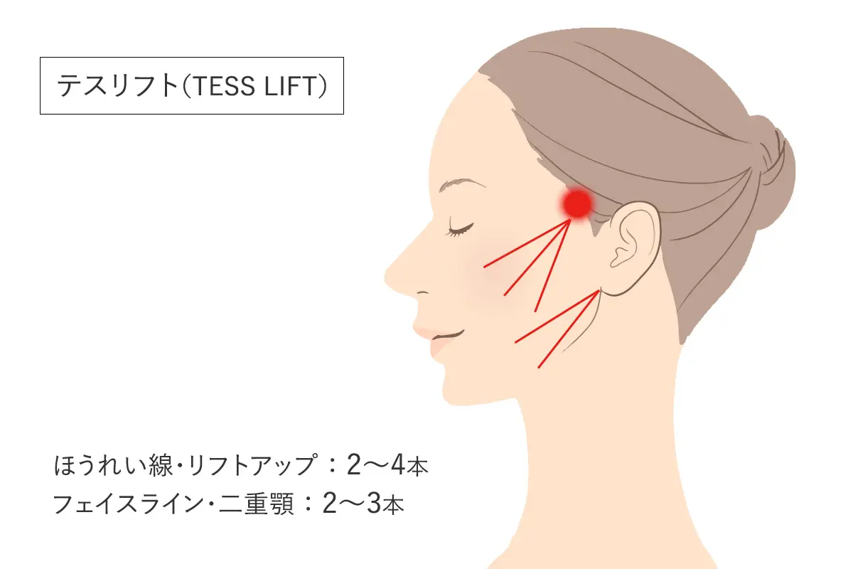 テスリフトの適応箇所と効果的な本数