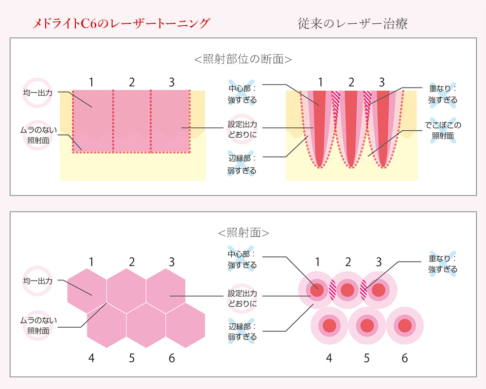レーザートーニングと従来のレーザー治療の違い
