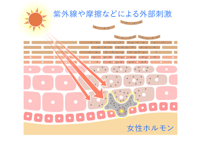 肝斑ができる要因は紫外線や摩擦などによる外部刺激