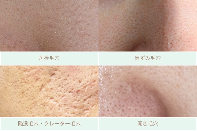 毛穴の種類