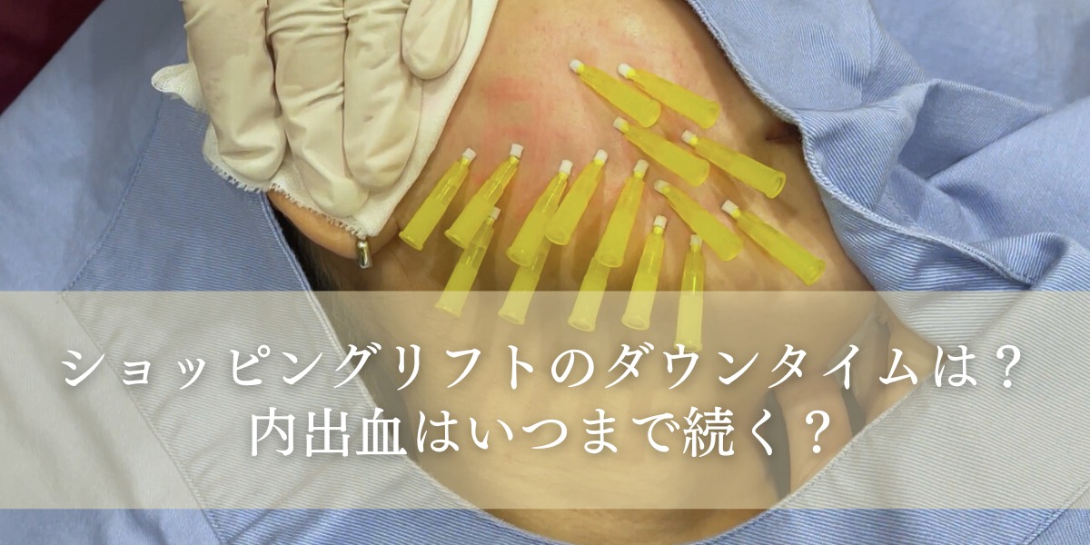 ショッピングリフトのダウンタイムは?内出血はいつまで続く?