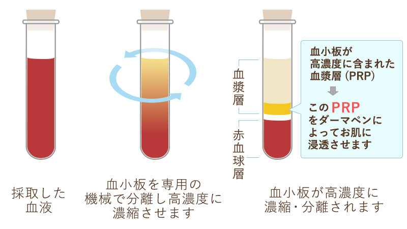 血小板が高濃度に含まれた血漿層(PRP)このPRPをダーマペンによってお肌に浸透させます
