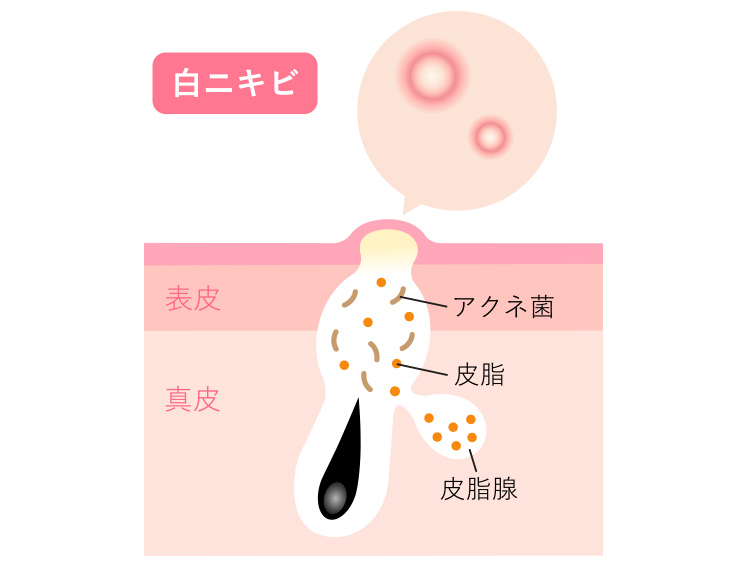 白ニキビとはニキビの初期段階といわれる状態