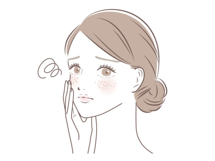肝斑に悩む女性