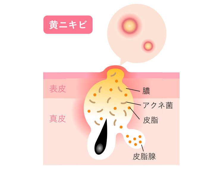 黄ニキビとは赤ニキビを放置しさらに悪化し、化膿した状態